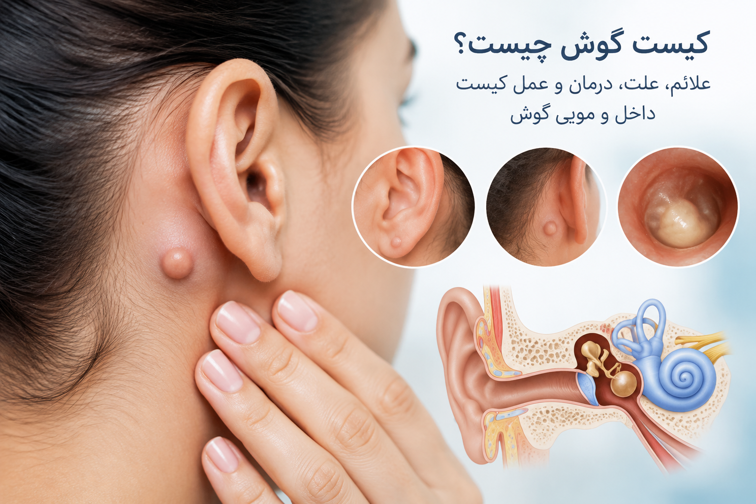 کیست گوش چیست؟ علائم، علت، درمان و عمل کیست داخل و مویی گوش