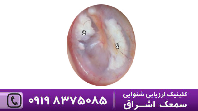 تمپانواسکلروزیس