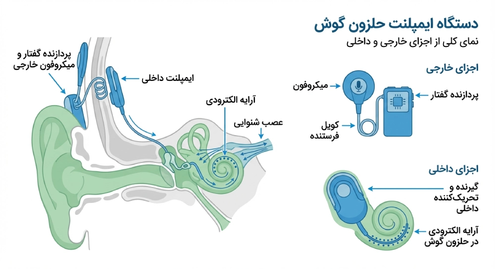 دستگاه کاشت حلزون