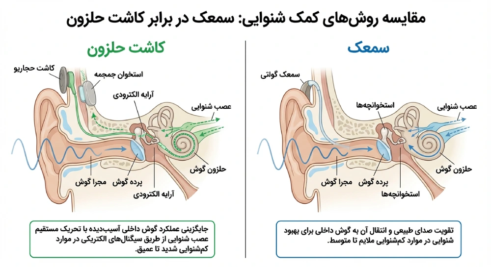 کاشت حلزون بهتر است یا سمعک